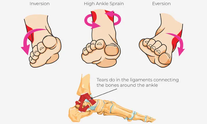 Ankle sprain
