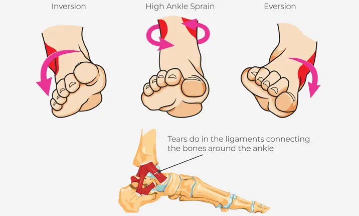 Ankle Sprain Treatment for a Complete Sprained Ankle Recovery