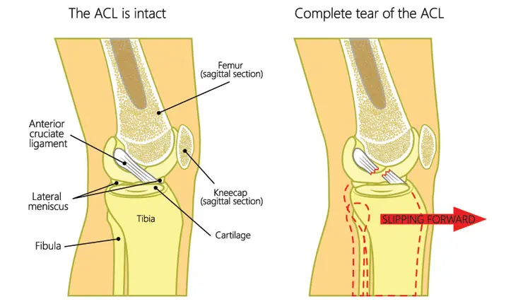 ACL injury