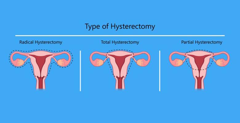 hysterectomy-surgery-in-hyderabad-indications-side-effects-cost