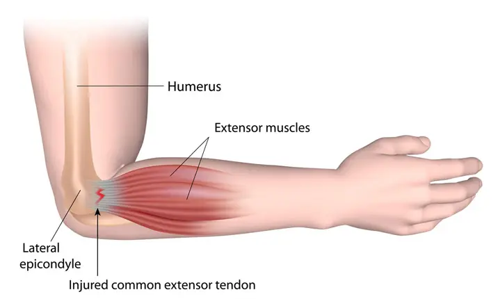 Crossfit and injuries - Tennis elbow