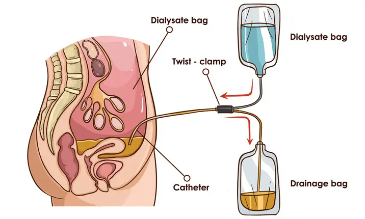 Peritoneal dialysis for kidney failure
