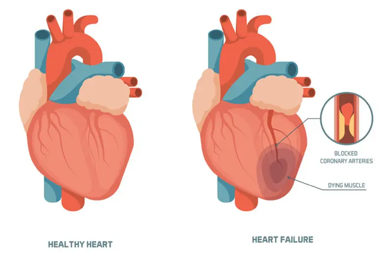 Heart failure is a serious condition in which the heart does not pump blood efficiently.