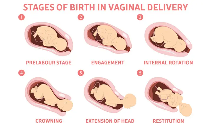 Factors determining the mode of delivery - C-section or Vaginal