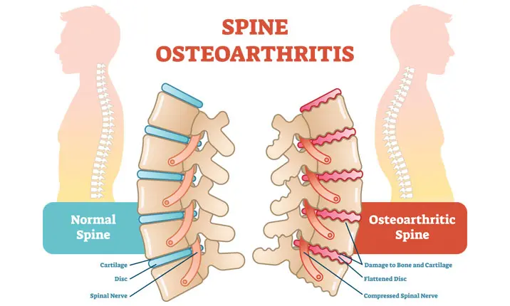 Degenerative spine complications arthritis