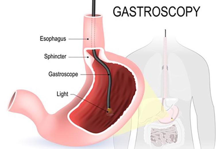 gastroscopy-stomach