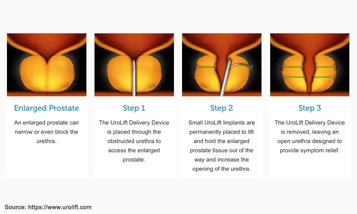 Three Signs You May Need a Breast Lift - Anh Vu, MD