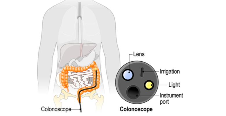 Crohn's Disease: What Is It & How It's Managed