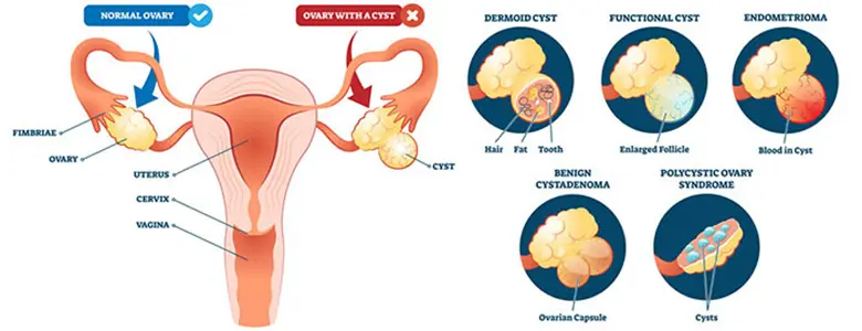cystectomy-ovarian-cyst-types