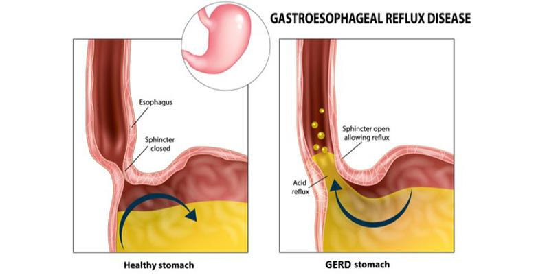 GERD 示意图