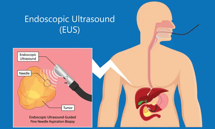 Ultrasonografi Endoskopik