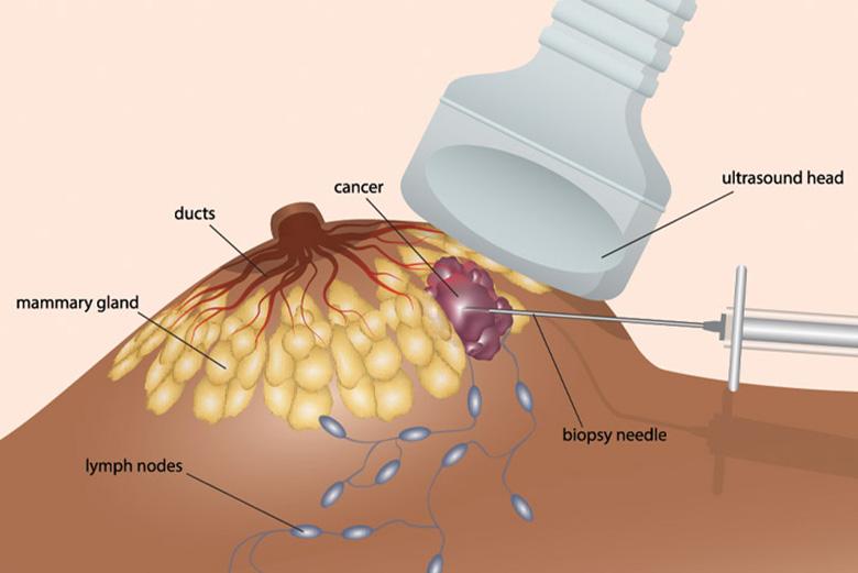 Vacuum-Assisted Biopsy