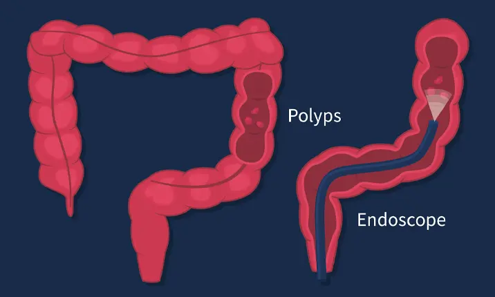 Gastroscopy and colonoscopy: key procedures to early detect