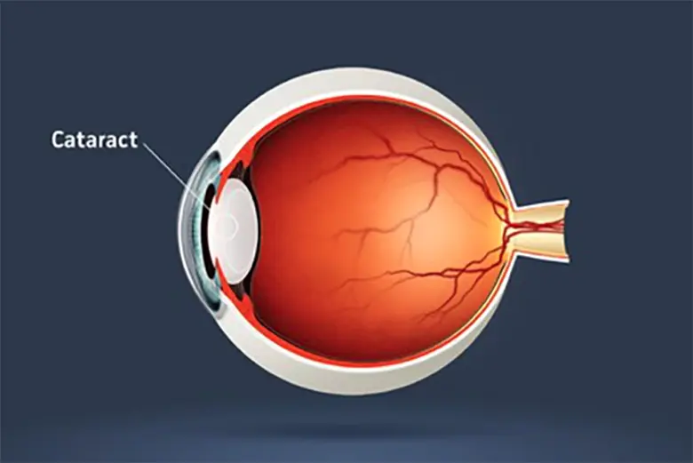 Cataract Surgery