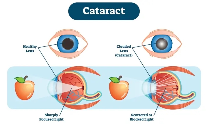 Cataract