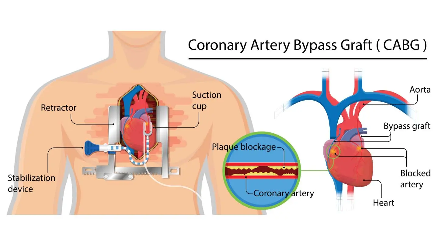 coronary-artery-bypass-grafting-cabg
