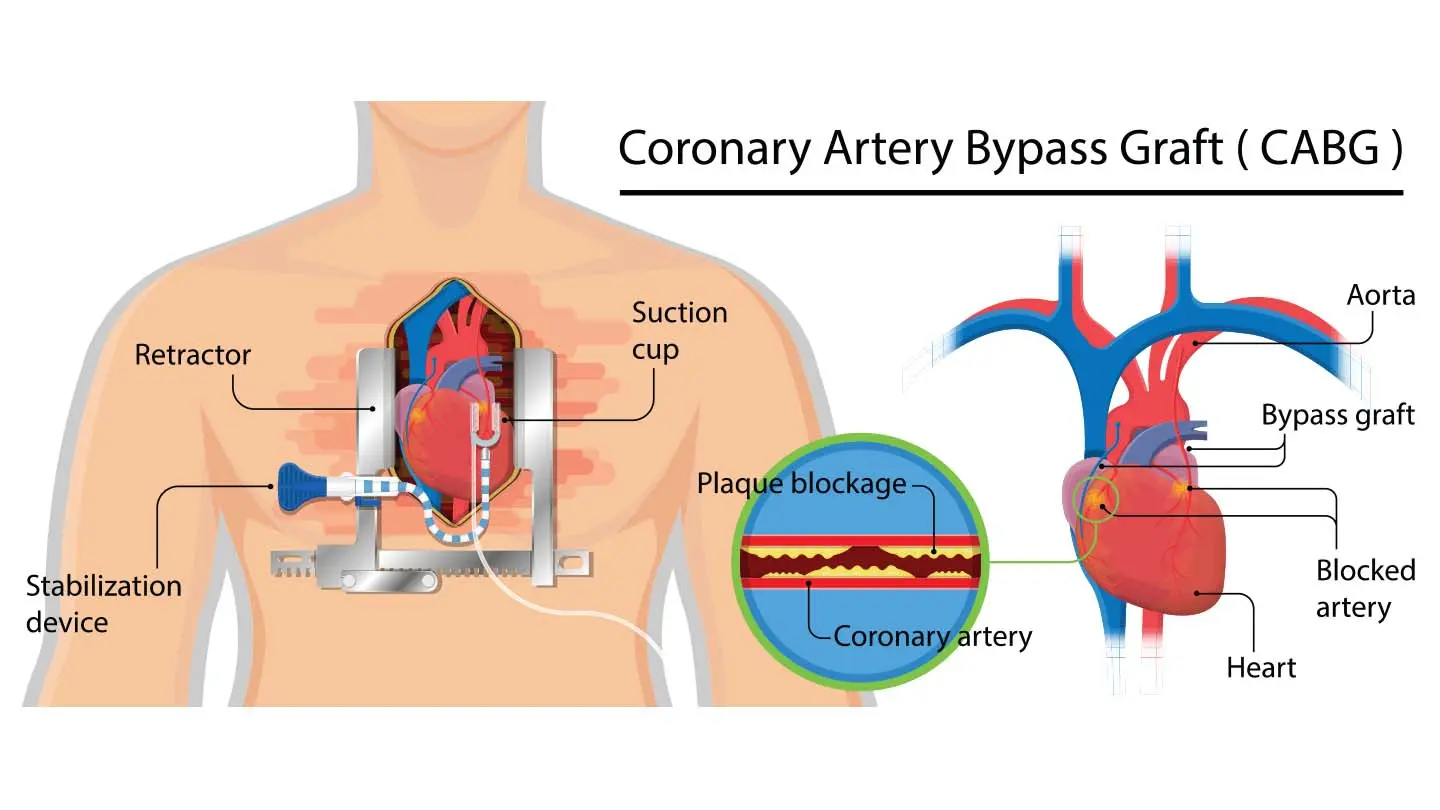 Clogged Artery Model, English-Spanish