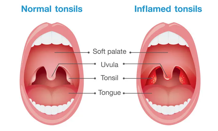What is tonsillitis?