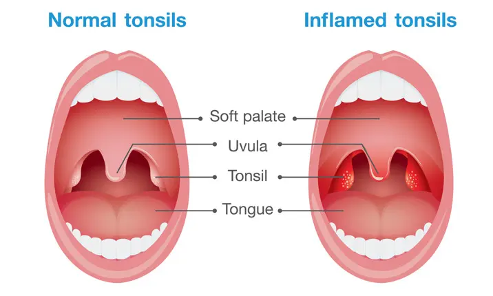 lingual tonsil cancer symptoms