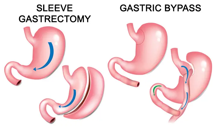 Types of metabolic surgery