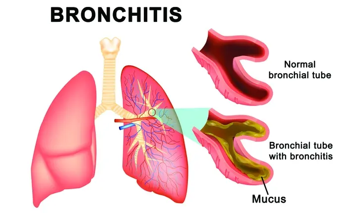 Chronic bronchitis – lung infection