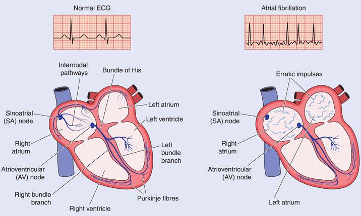 Arrhythmia: How Is Irregular Heartbeat Diagnosed?