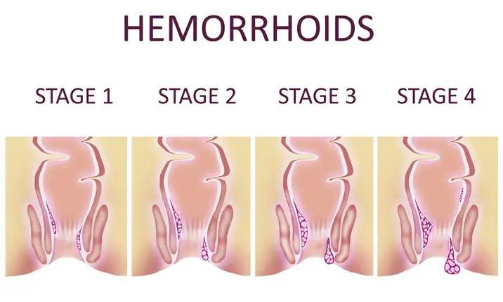 What are haemorrhoids?