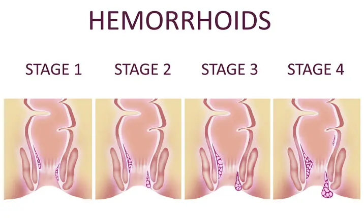 external hemorrhoid stages