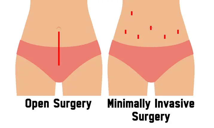 Open surgery vs MIS
