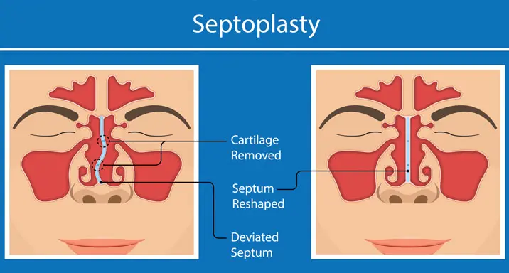 Septoplasty
