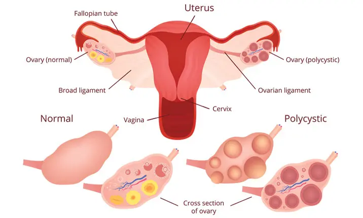 Ovarian cysts