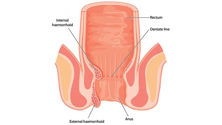 Haemorrhoids