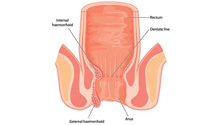 Symptoms of Piles in Female - Images, Reasons and Treatment