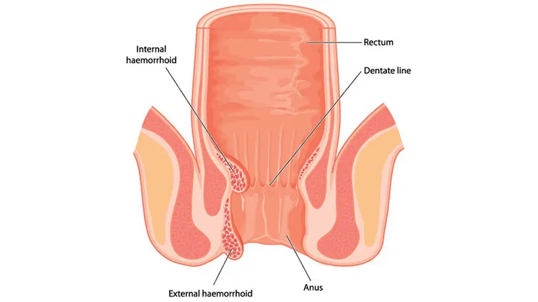 All You Ever Wanted To Know About Piles - Penang Surgeon