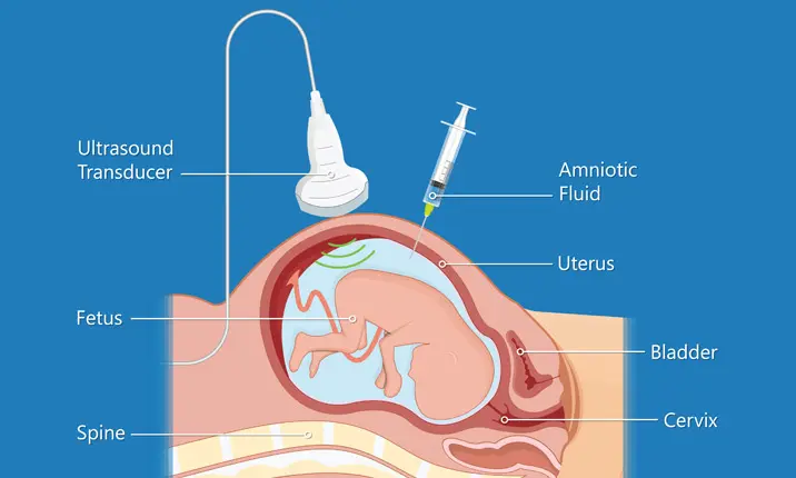 Amniocentesis