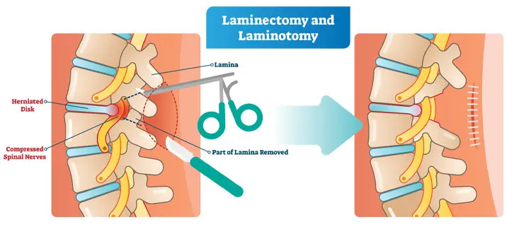 Laminectomy for spinal stenosis
