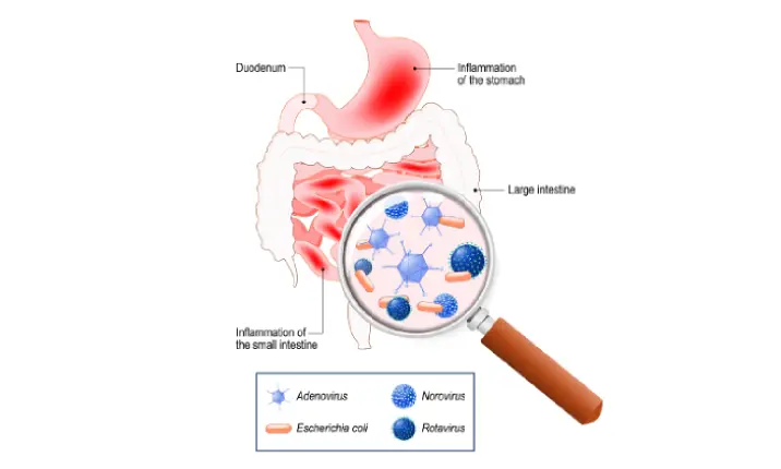 acute gastroenteritis symptoms