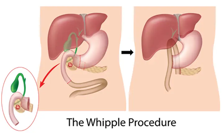 Whipple procedure