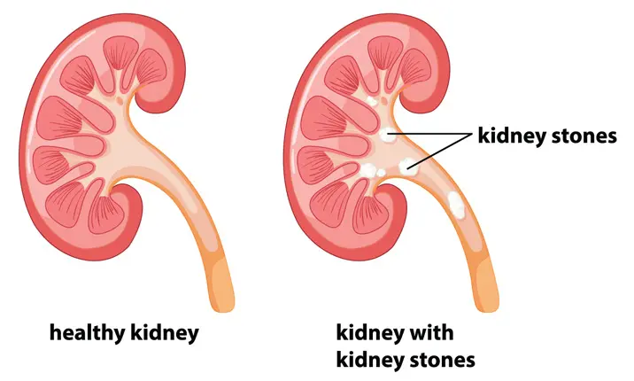 Can kidney stones go away on their own?