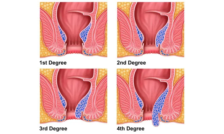 Piles in Men - Problems, Causes, Symptoms and Treatment