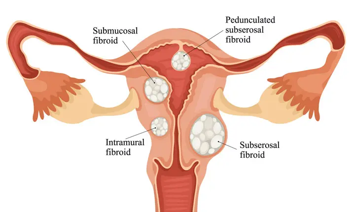 uterine cysts