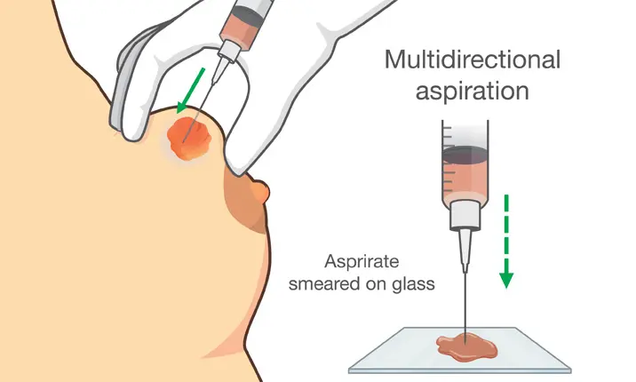 Fine-needle aspiration biopsy