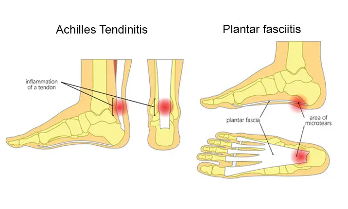 Achilles tendinitis and plantar fasciitis