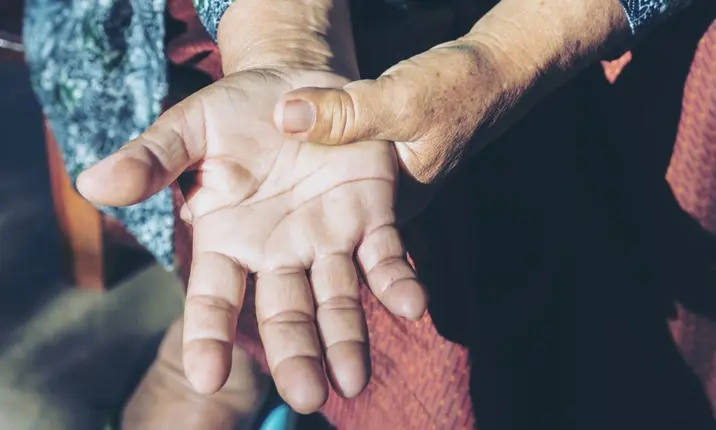 Rheumatoid arthritis hand