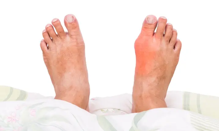 Signs and symptoms of gout