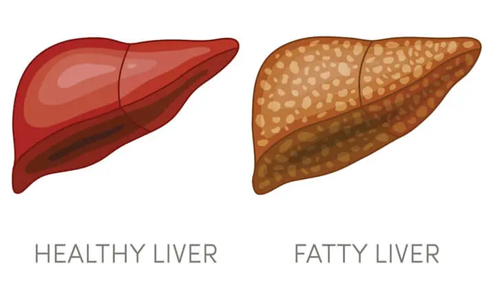 Fatty liver vs healthy liver