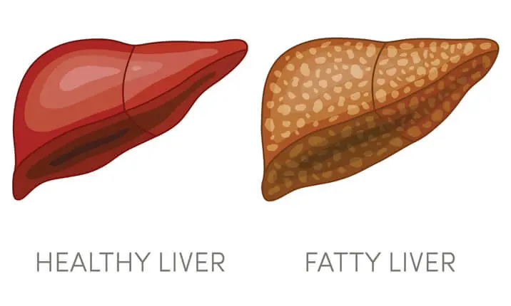 10 Common Food Choices for People with Fatty Liver Disease