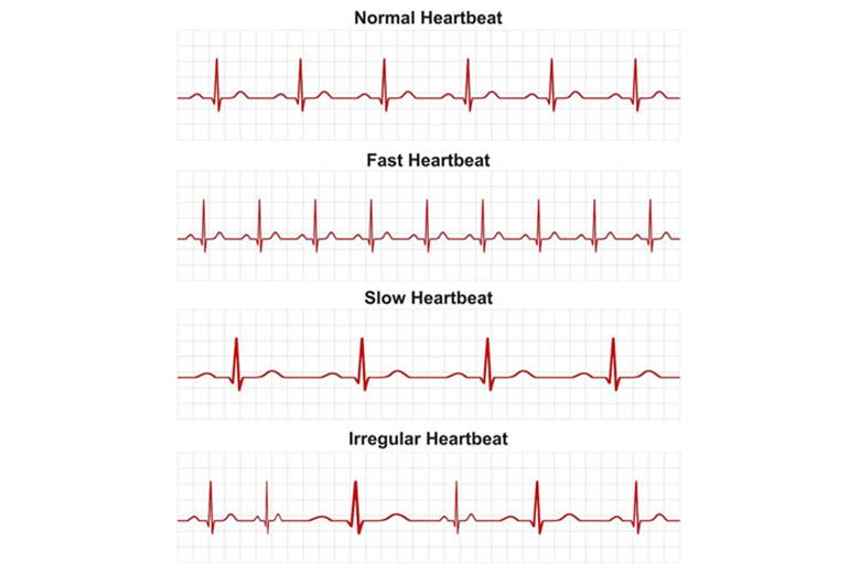 Heart Arrhythmias - Symptoms & Causes | Gleneagles Hospital