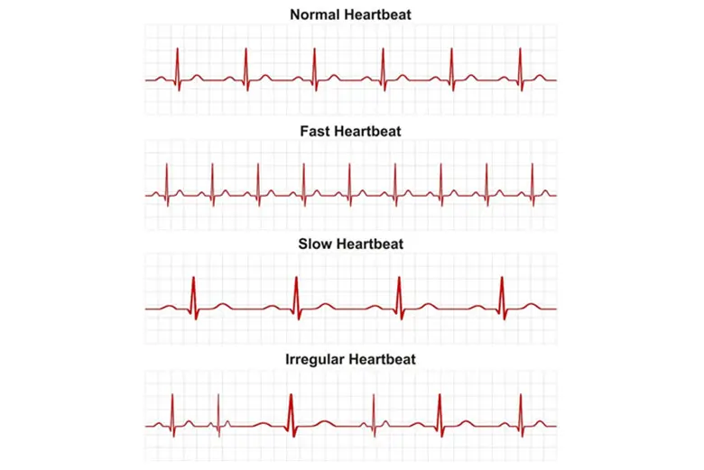 Rối loạn nhịp tim là tình trạng tim đập quá nhanh, quá chậm hoặc không đều.