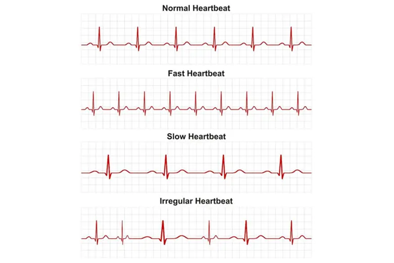 Heart Arrhythmias - Symptoms & Causes